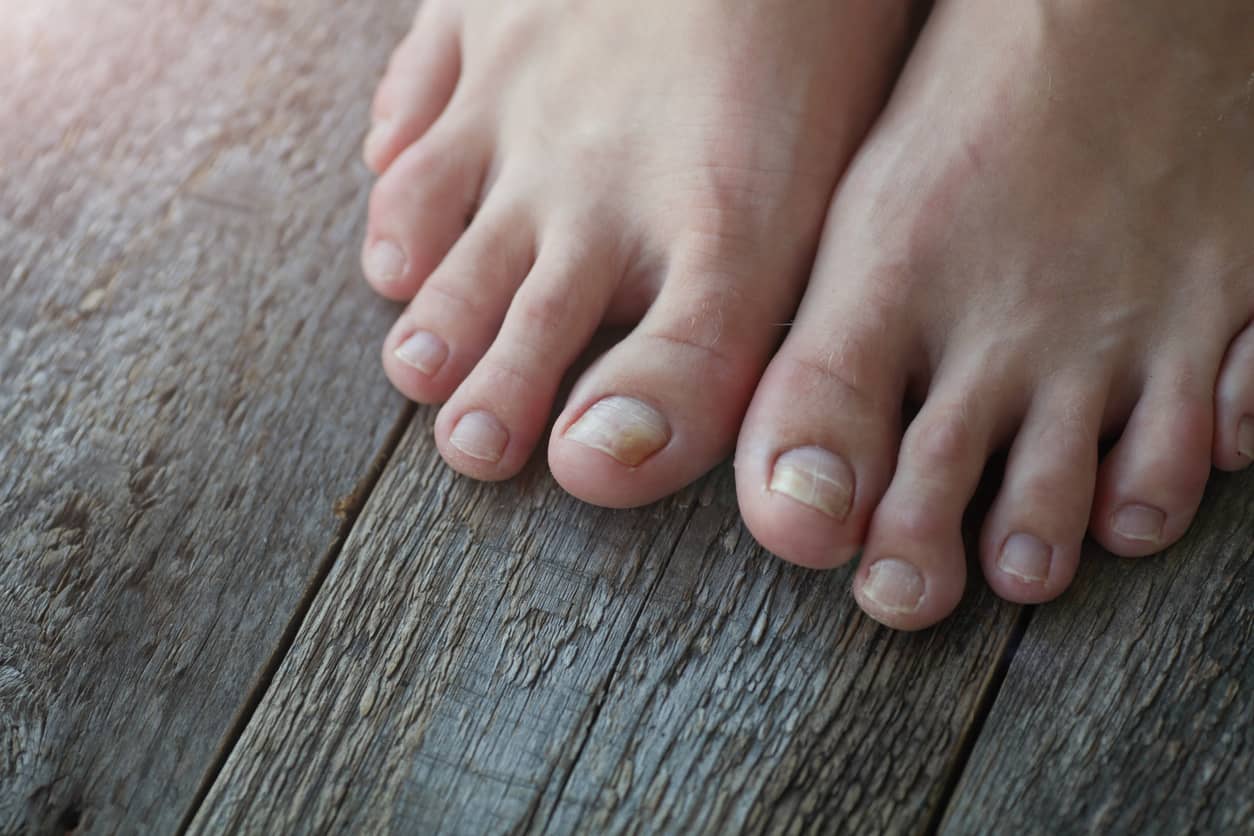 Nail Fungus Laser Treatment in Singapore | Nail Fungus Specialist